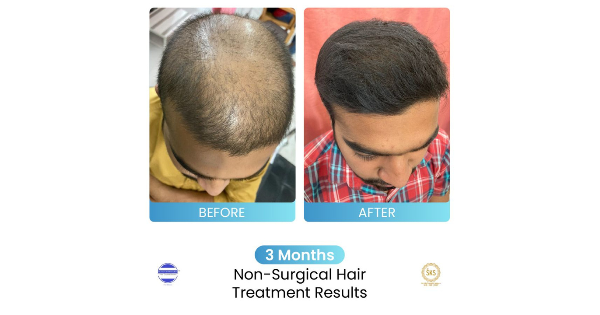 Dr. Stuti Khare Shukla’s Non-Surgical Hair Growth Booster helping multiple people suffering from Hair Loss Issues